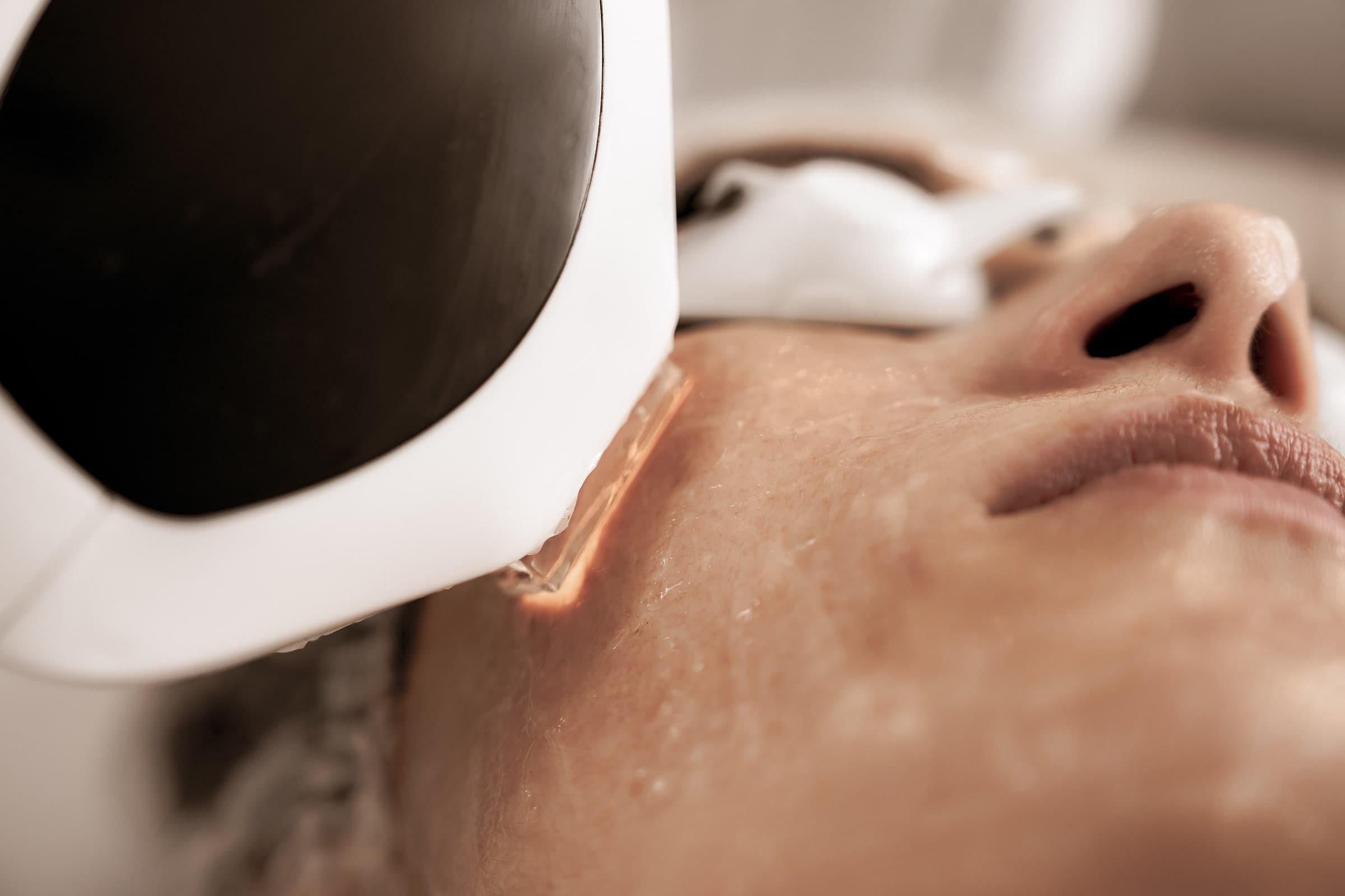 Excel V+ laser handpiece treating the cheek during a dermatology session
