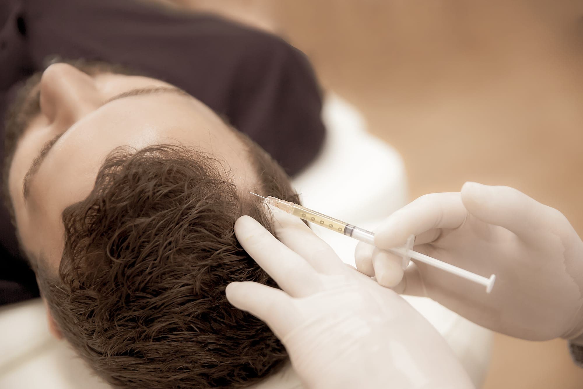 PRP/PRFM for Hair Loss