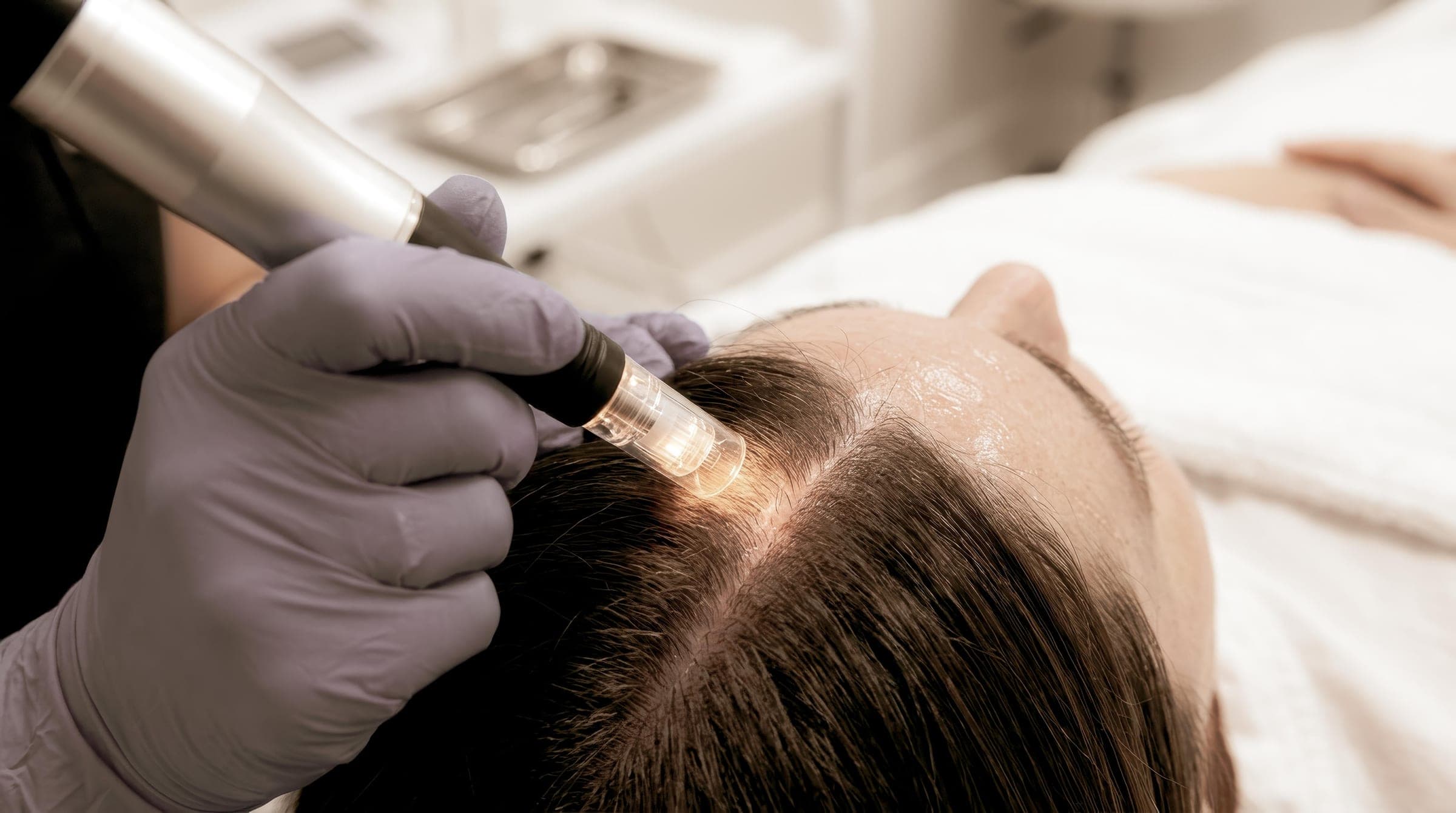 Scalp microneedling treatment for hair thinning and hair loss