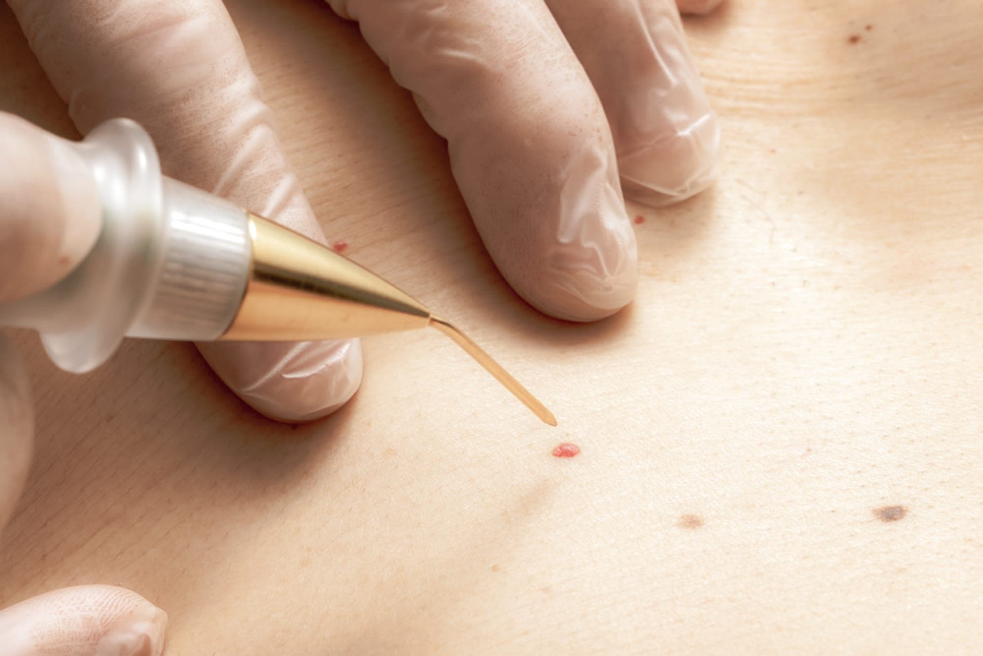 Cherry angioma removal procedure