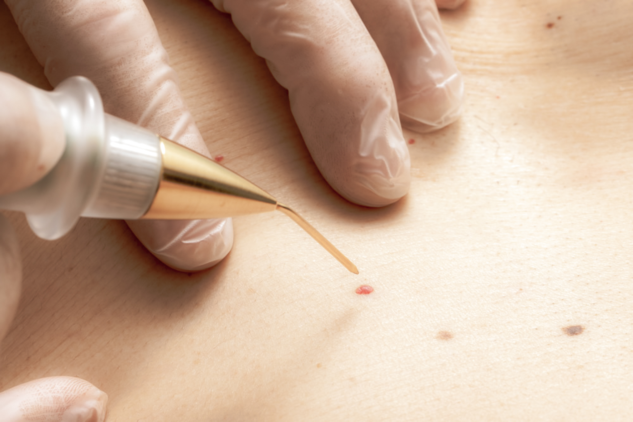 Cherry angioma removal procedure